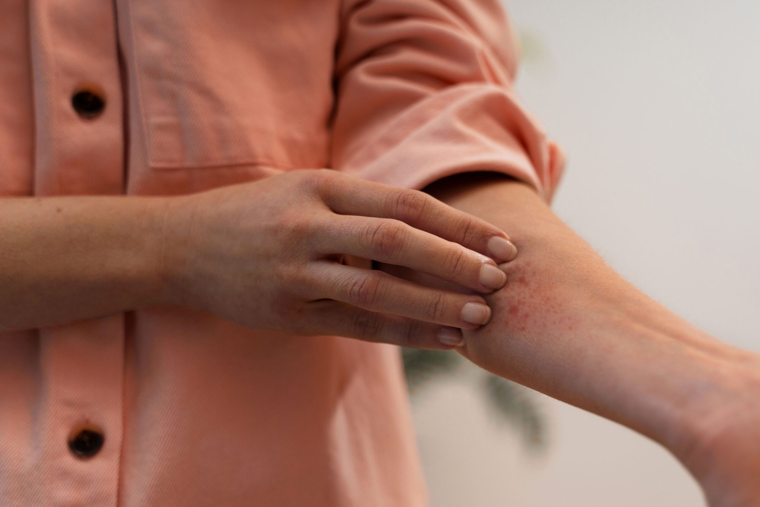 Tem dermatite atópica? Pode ser sinal de alerta para mais doenças alérgicas