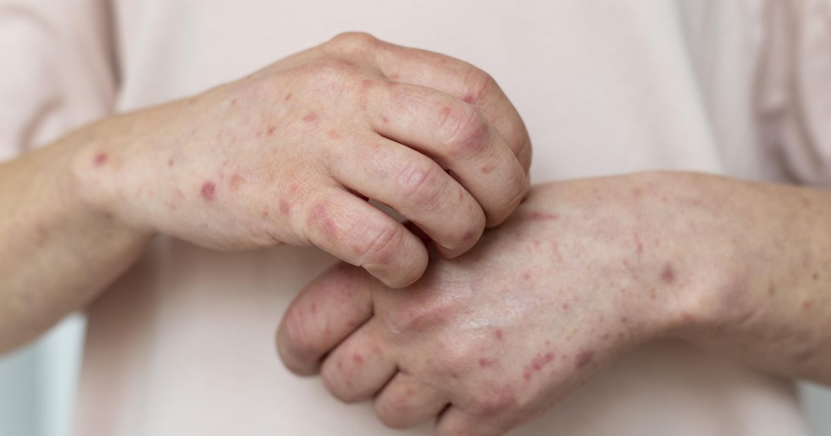 OMS: aumento de casos faz eliminação global do sarampo ser “meta distante”