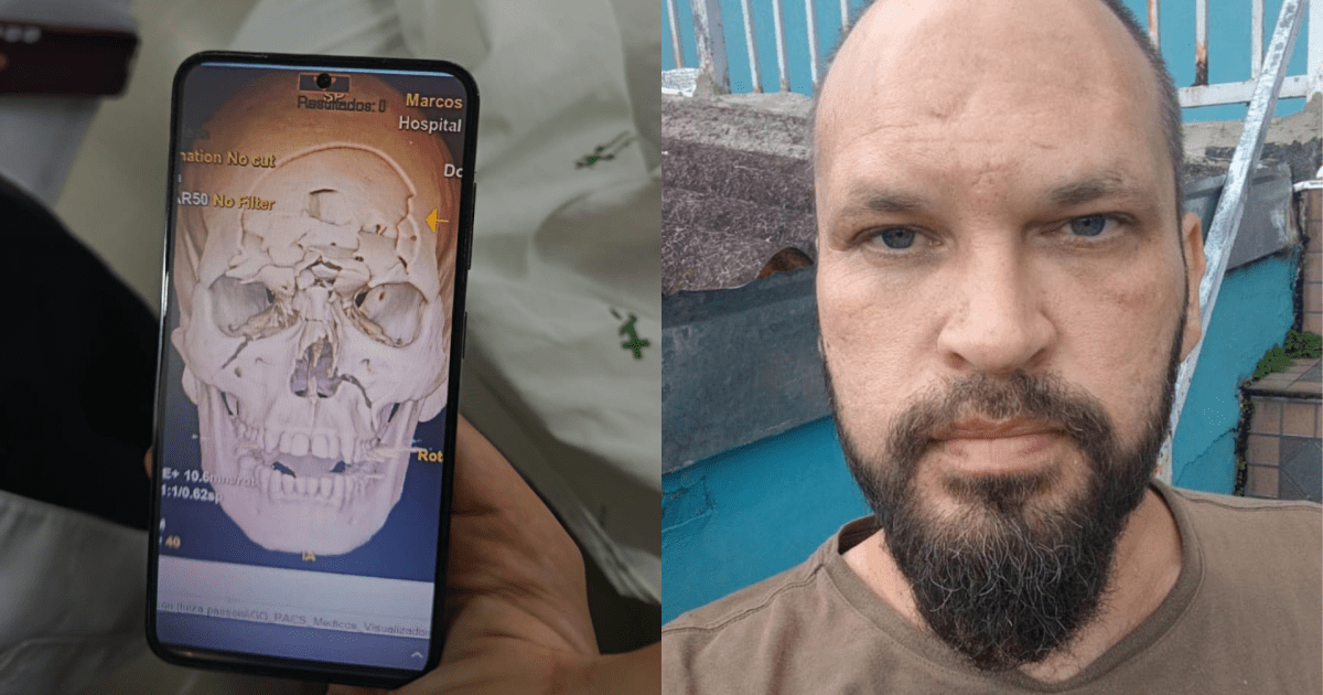 Motociclista se recupera após ter crânio “triturado” em acidente no PR